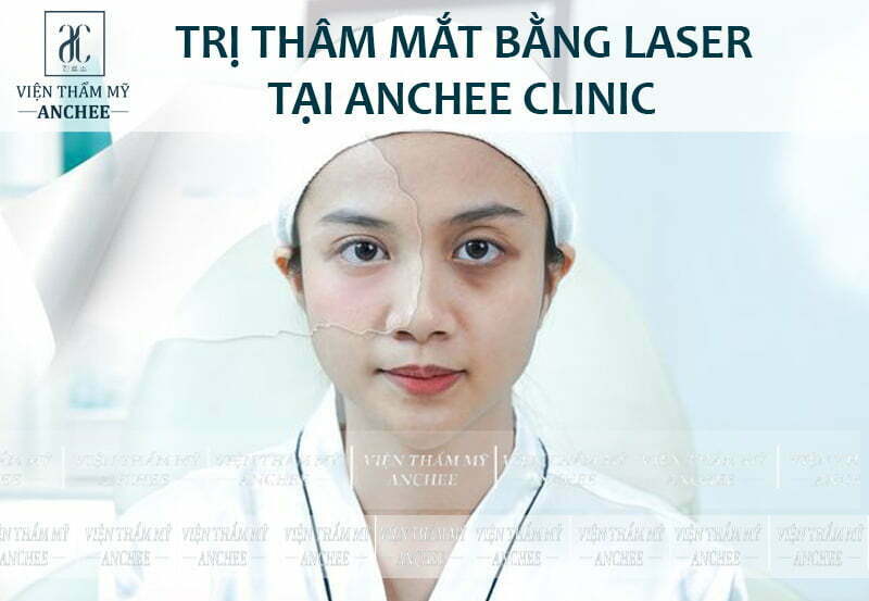Trị dứt điểm quầng thâm mắt bằng công nghệ Laser tại Anchee Clinic