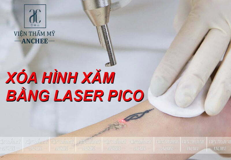 Chi Phí Xoá Xăm Hết Bao Nhiêu Tiền Giá Xoá Xăm Laser 2023