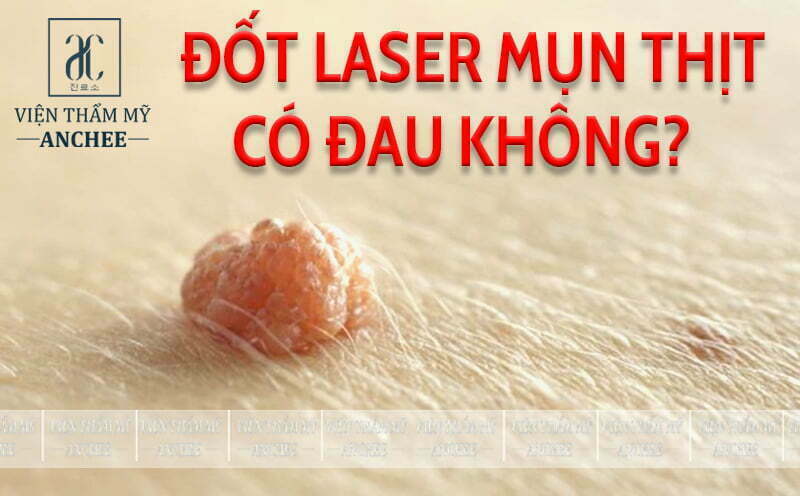 Đốt Mụn Thịt Bằng Tia Laser Bao Nhiêu Tiền? Bảng Giá #2023