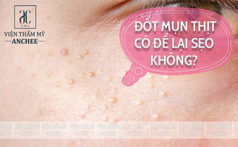 Đốt Mụn Thịt Bằng Tia Laser Bao Nhiêu Tiền? Bảng Giá #2023