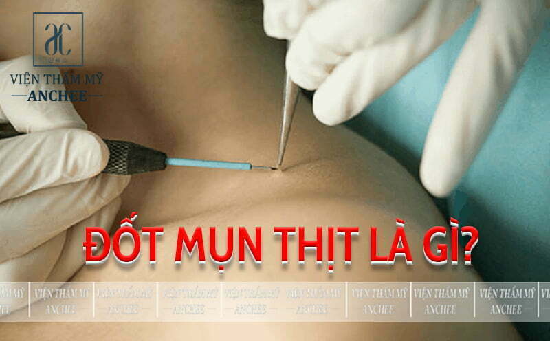 Đốt Mụn Thịt Bằng Tia Laser Bao Nhiêu Tiền? Bảng Giá #2023
