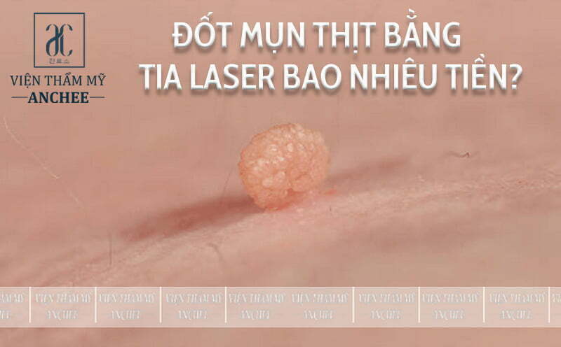 Đốt Mụn Thịt Bằng Tia Laser Bao Nhiêu Tiền? Bảng Giá #2023