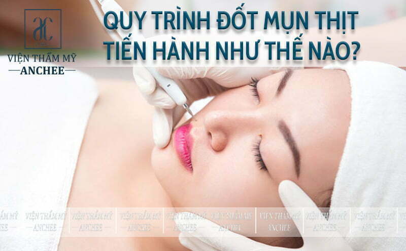 Đốt Mụn Thịt Bằng Tia Laser Bao Nhiêu Tiền? Bảng Giá #2023