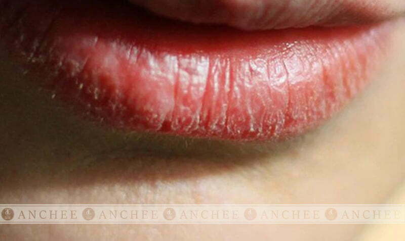 3 Lý do phun môi bị bong da nhiều lần & 5 Cách khắc phục