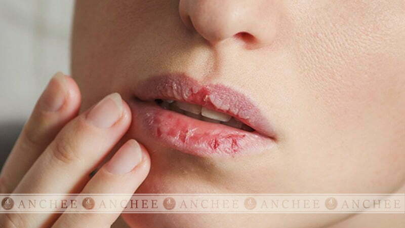 Phun môi xong bị nứt chảy máu - Cách khắc phục hiệu quả