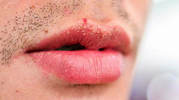 Phun môi bị lên mụn liti: 2 Nguyên nhân & Cách khắc phục