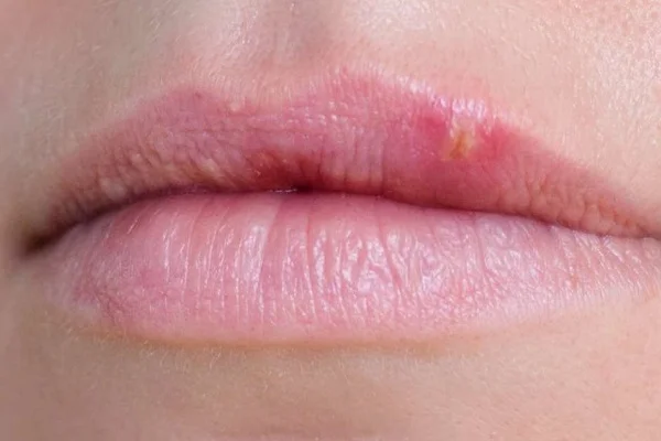 Phun môi bị nổi mụn trắng – Nguyên nhân và cách khắc phục