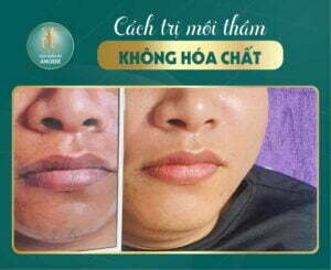 cách trị môi thâm