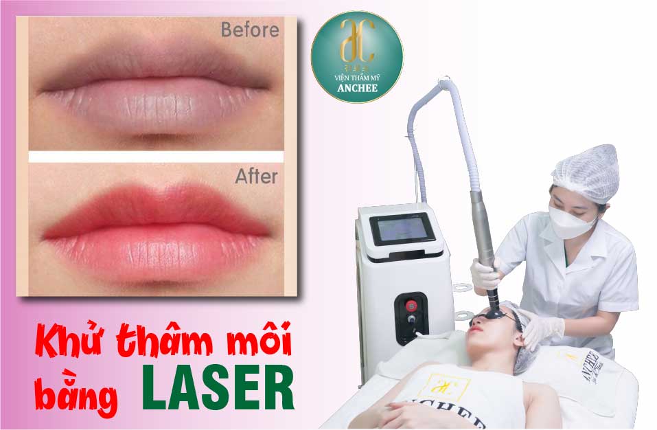 khử thâm môi bằng laser