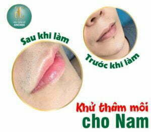 khử thâm môi nam
