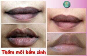 môi thâm bẩm sinh