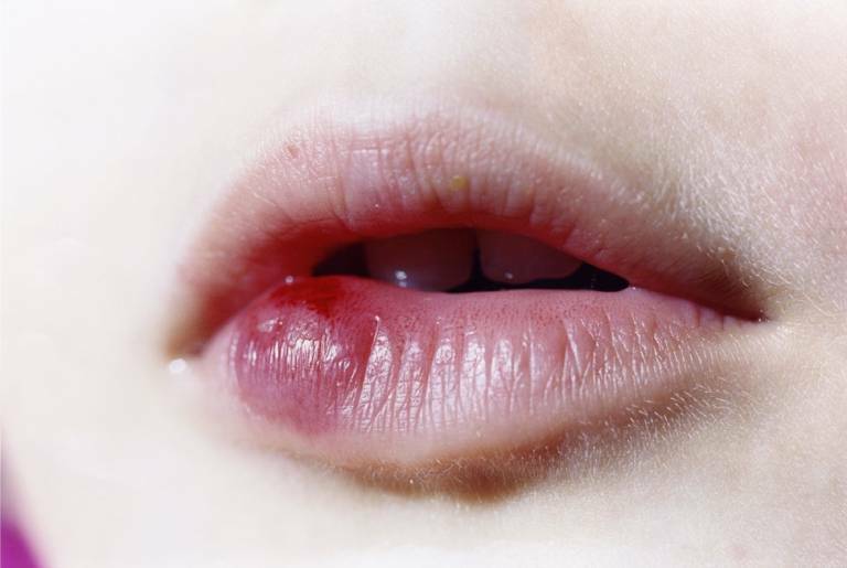 Phun môi bị sưng đỏ bao lâu thì hết? Uống thuốc gì để hết sưng?