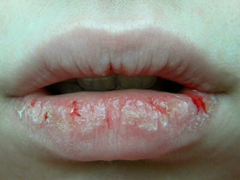 Phun môi xong bị nứt chảy máu