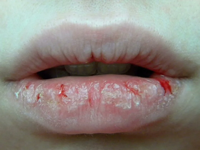 Phun môi xong bị nứt chảy máu