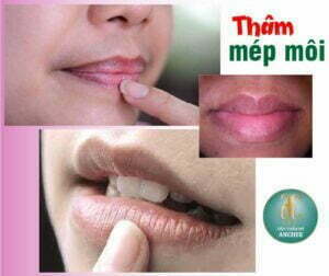 thâm mép môi