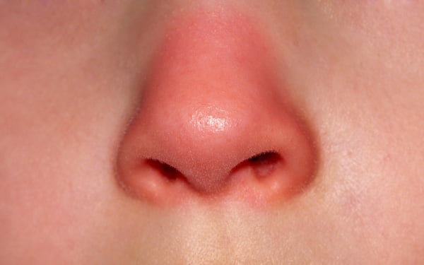Tiêm filler mũi bị tràn - Dấu hiệu, Nguyên nhân và Cách khắc phục
