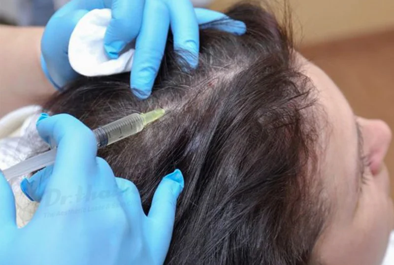 Tiêm mọc tóc bằng phương pháp Mesotherapy hiệu quả bất ngờ