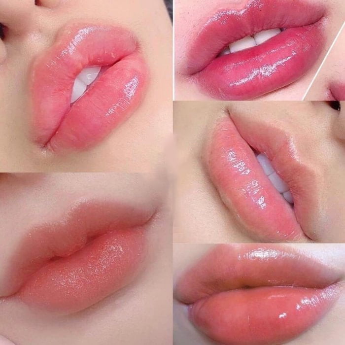 Tiêm môi cherry [Filler] - Điểm danh 5 dáng môi “HOT” & Đẹp nhất