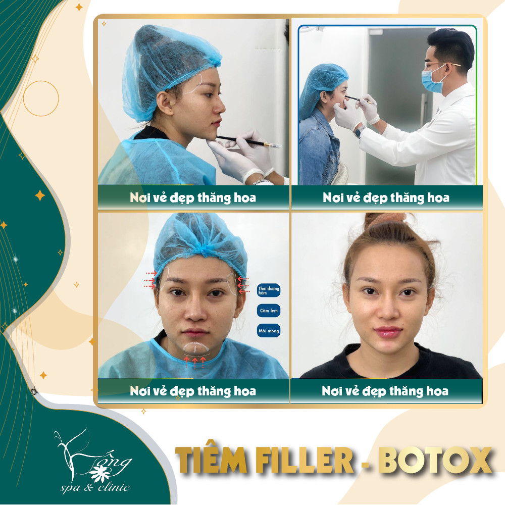 Sử dụng Botox và Filler để giúp thon gọn mặt không cần phẫu thuật