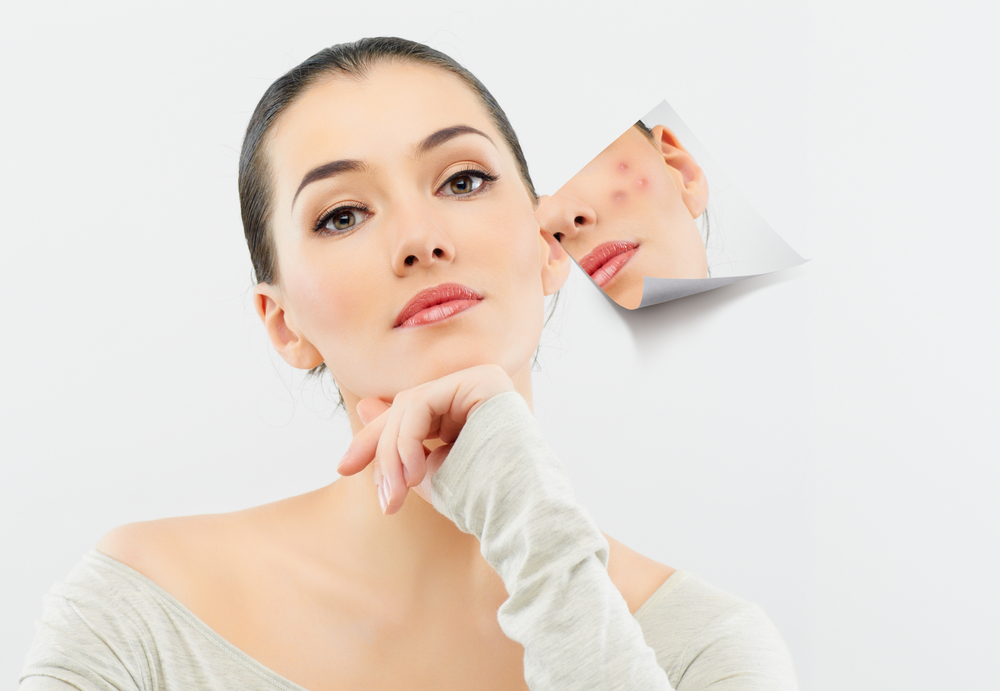 Lăn kim trị sẹo rỗ - Liệu pháp điều trị mang lại vẻ đẹp cho làn da
