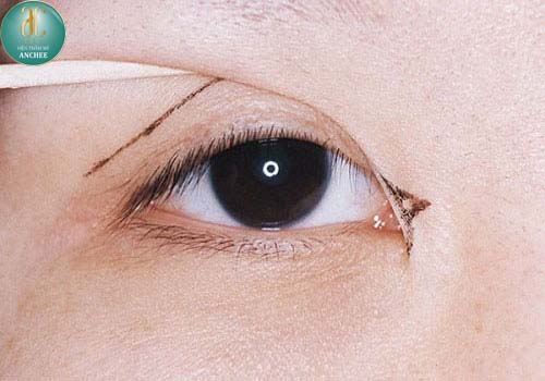 Mở góc mắt trong bị sẹo nguyên nhân do đâu? Bao lâu thì lành hẳn?