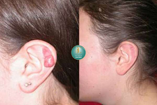 Sẹo lồi ở tai - Nguyên nhân do đâu và 8 cách điều trị hiệu quả 99,9%