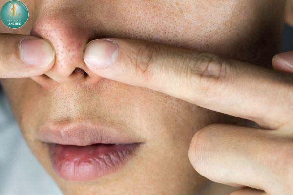 TOP 8 Cách điều trị sẹo rỗ ở mũi nhanh chóng hiệu quả ngay tại nhà