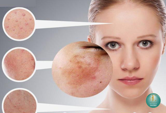 TOP 14 Cách chăm sóc da mặt bị nám & tàn nhang giúp da trắng sáng mịn màng