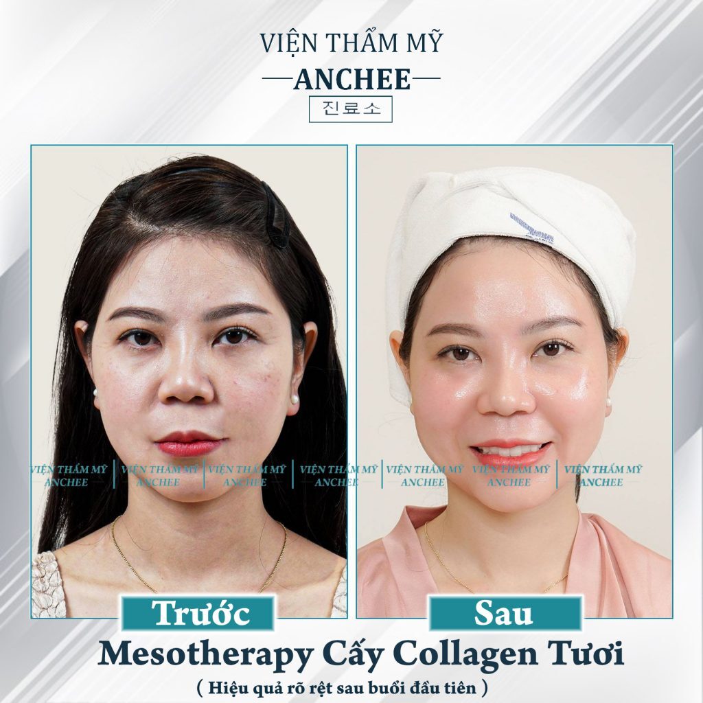 Review Tiêm Meso (Mesotherapy): Công Dụng, Quy Trình - Địa Chỉ Tiêm