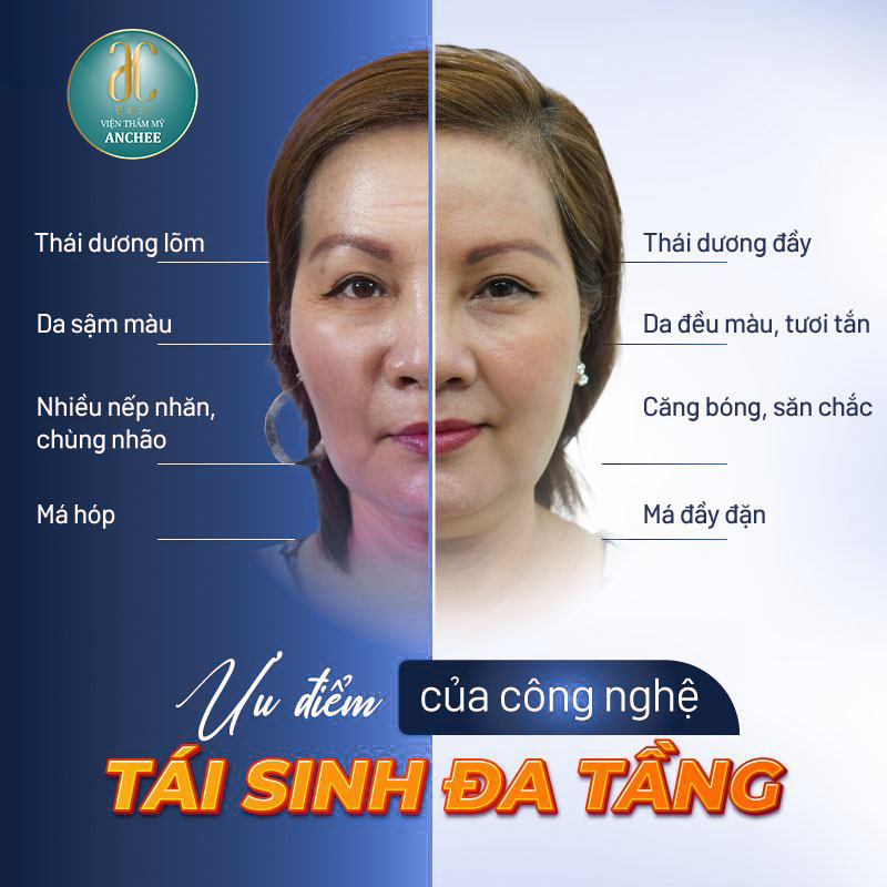 Tái Sinh Đa Tầng Là Gì? Giá Bao Nhiêu? Ưu Điểm & Quy Trình